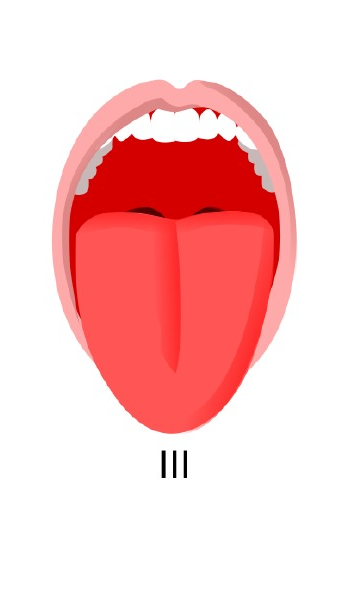 Mallampati III