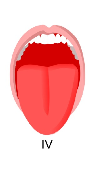 Mallampati IV